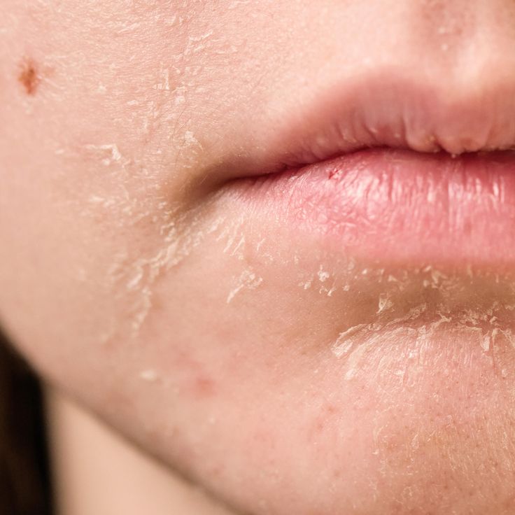 Labios, manos, rostro: SOS de invierno (y cómo responder)