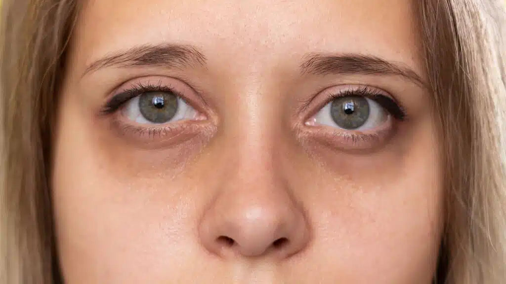 Ingredientes ideales para cada tipo de ojera (y cómo devolverle el brillo a tu mirada)