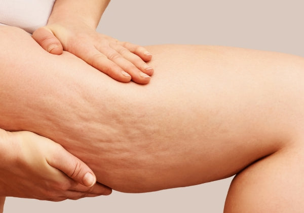 Cómo reducir la celulitis: tratamientos que funcionan