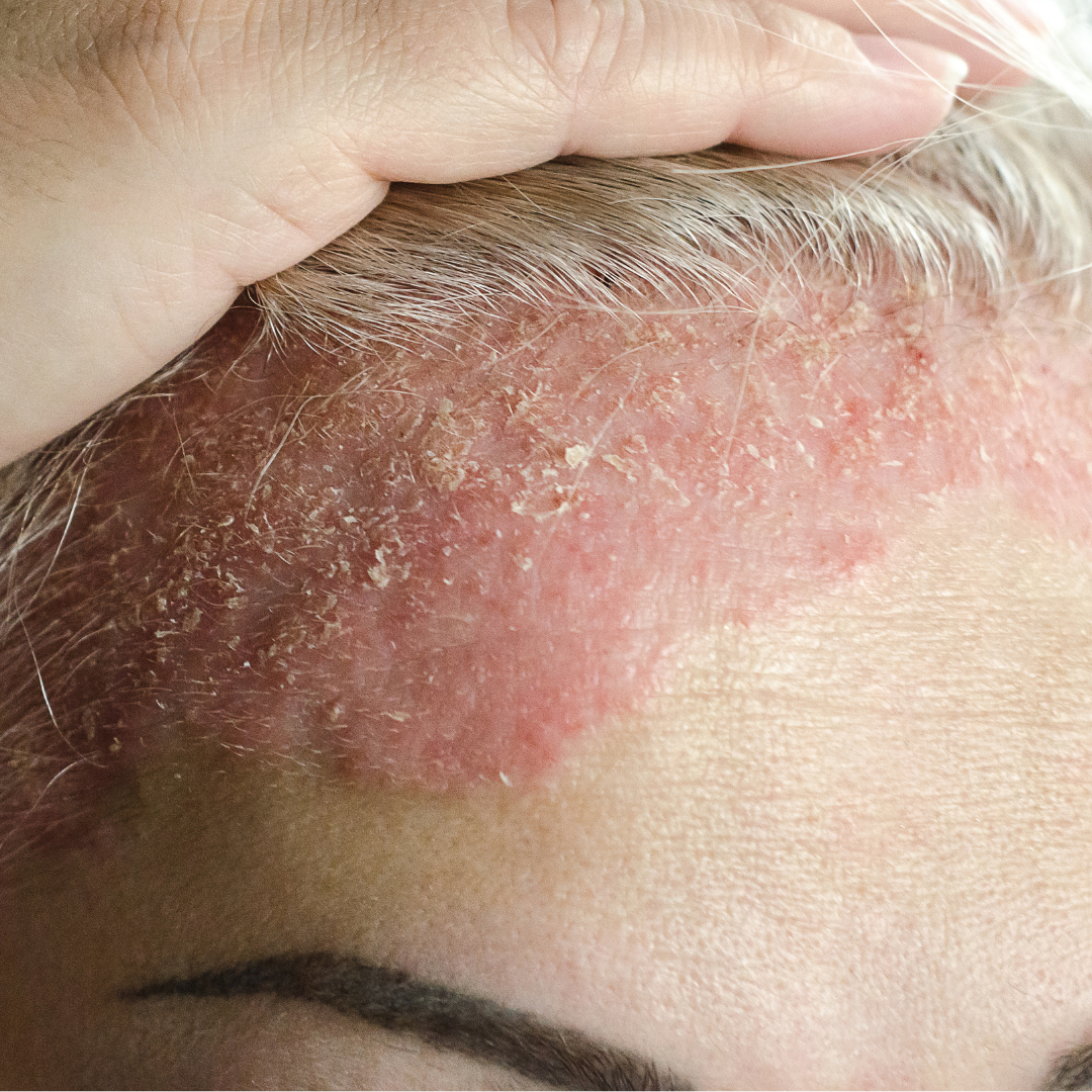 Rutina efectiva para calmar la dermatitis seborreica con suavidad