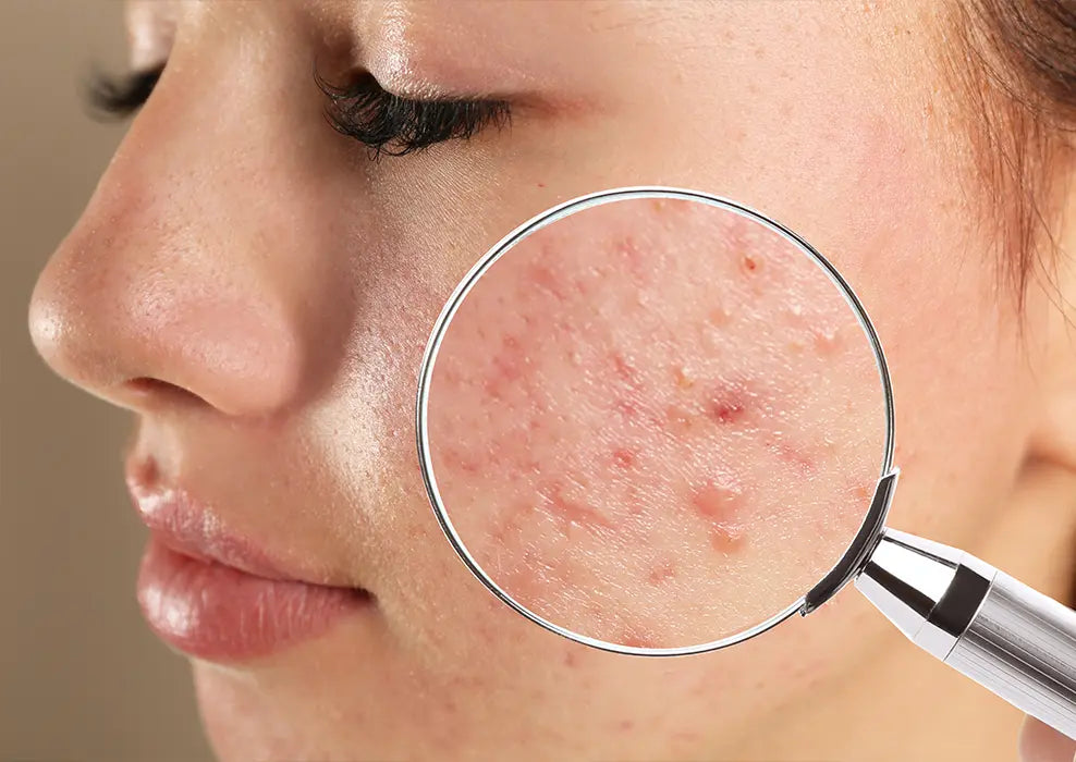 Rutina efectiva para eliminar y prevenir el acné