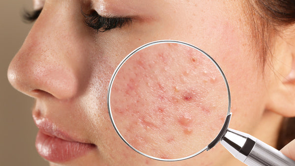 Rutina para combatir el acné